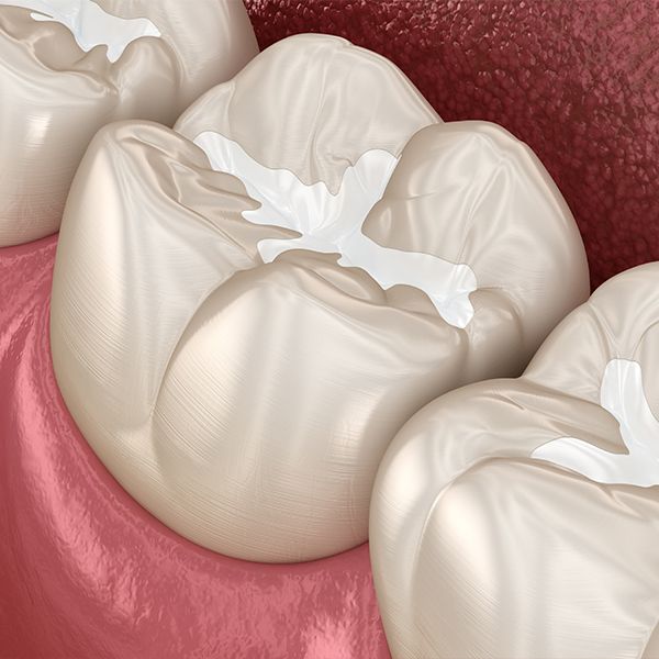 Tooth-colored filling