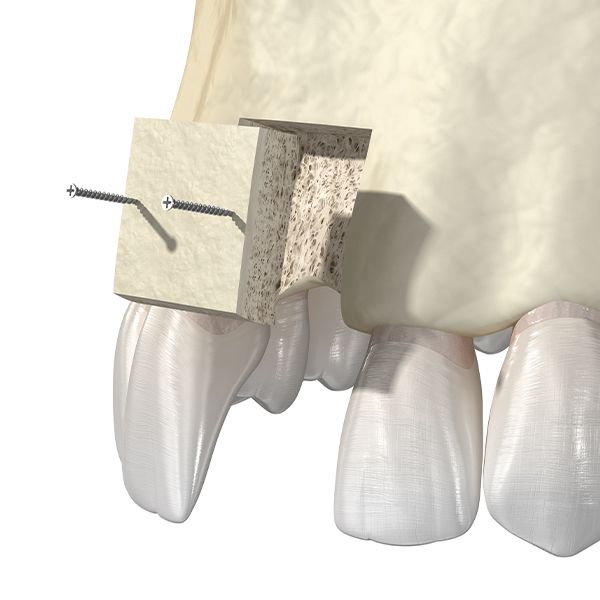 Bone Graft
