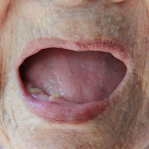 woman with missing teeth