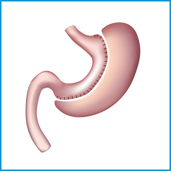 Sleeve Gastrectomy