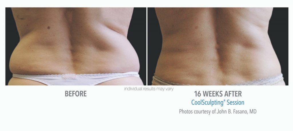 Coolsculpting Before & After