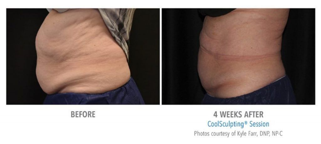Coolsculpting Before & After