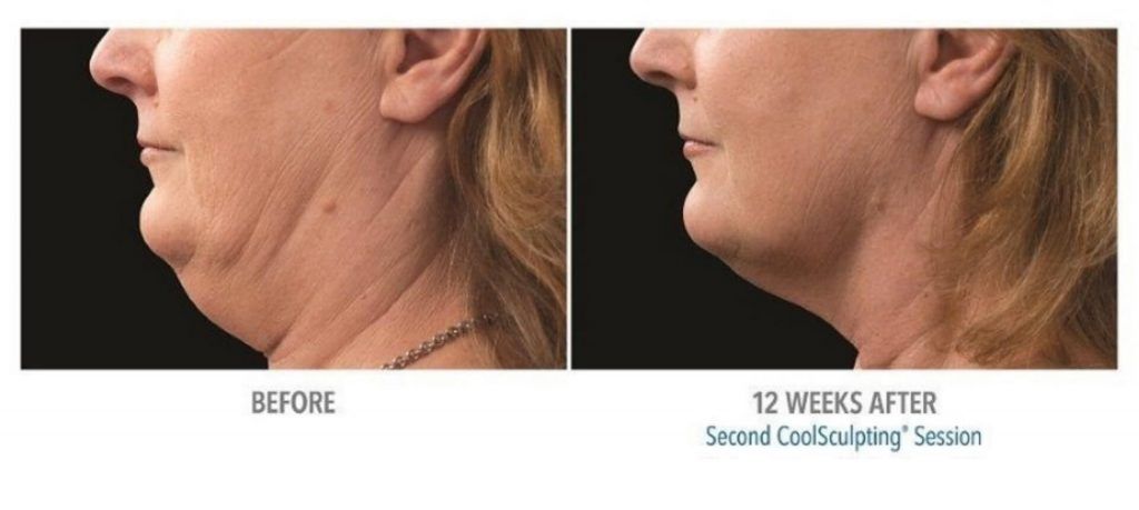 Coolsculpting Before & After
