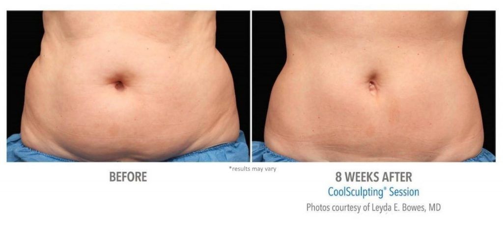 Coolsculpting Before & After
