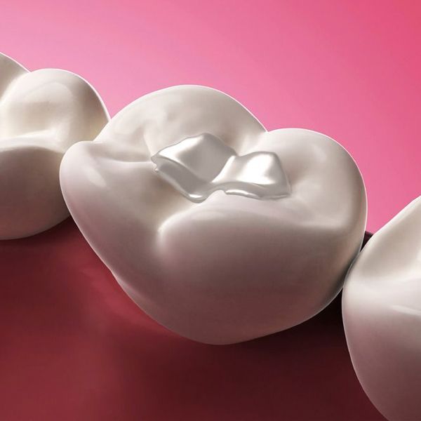 Dental Fillings