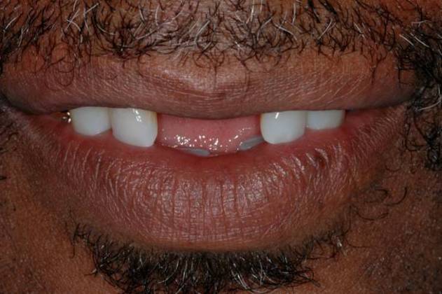 Before bridge placement