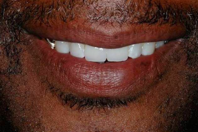 After bridge placement