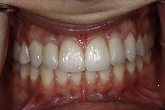 After dental implants