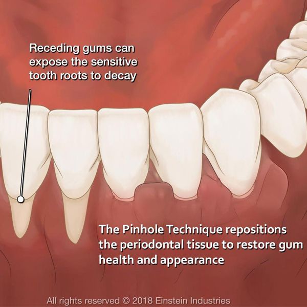Chao Pinhole Surgical Technique