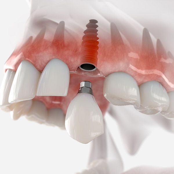 Dental Implants