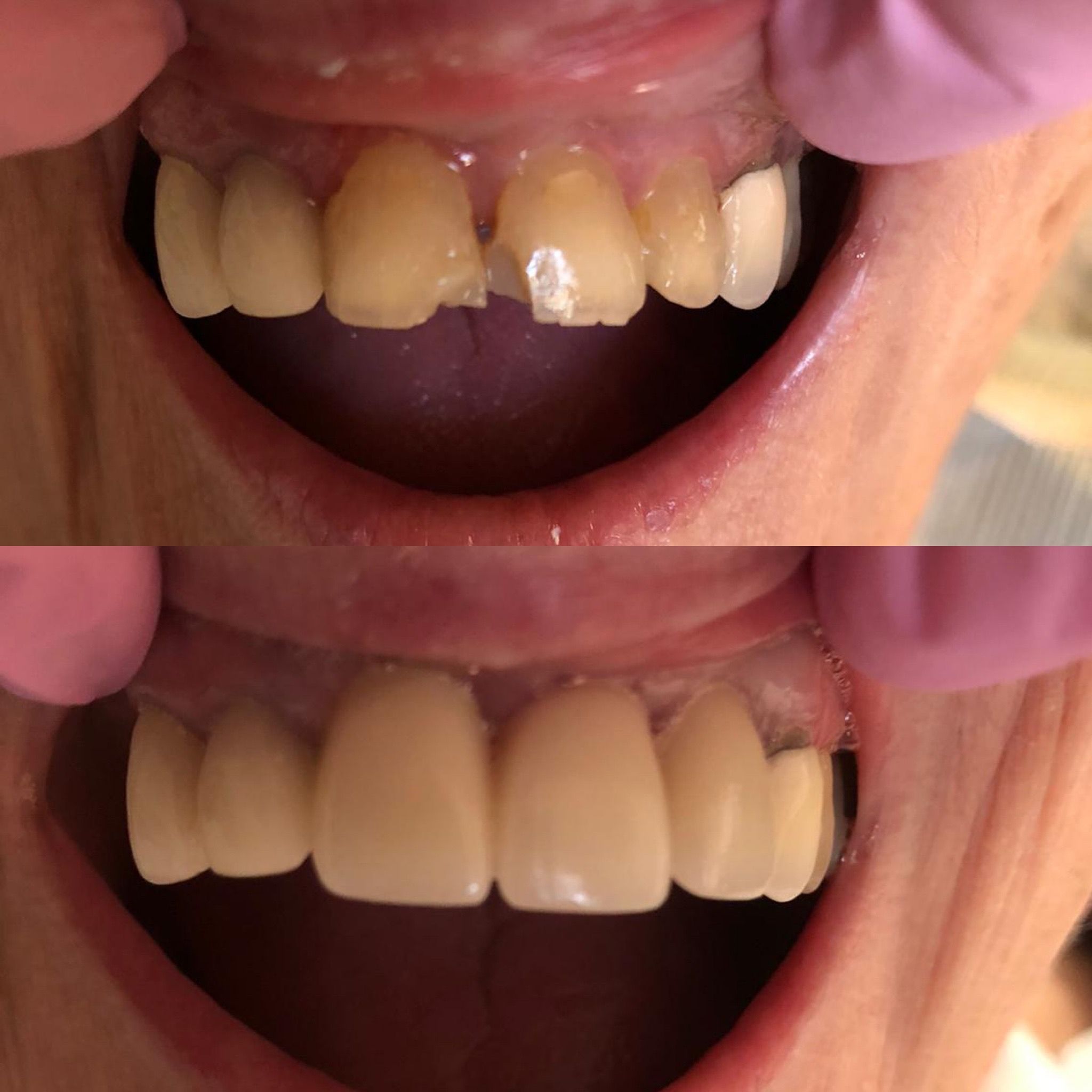 After smile makeover