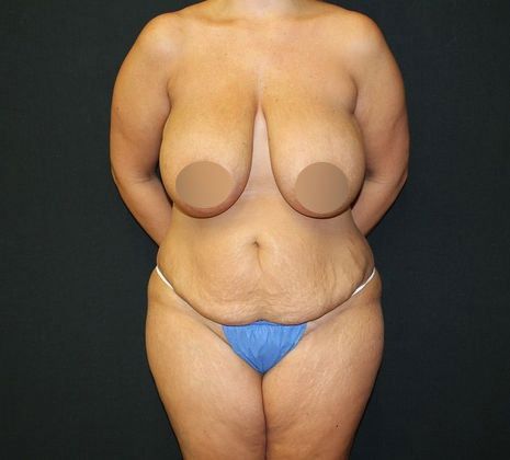 Before mommy makeover (from front)