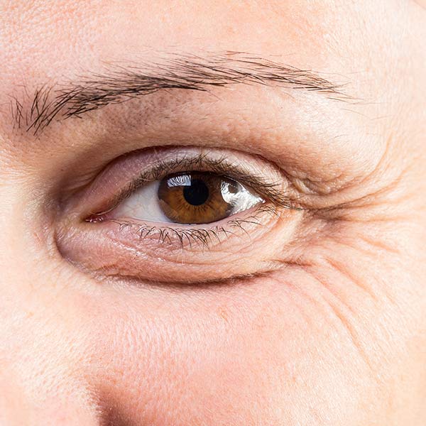 Wrinkles around a woman's eyes