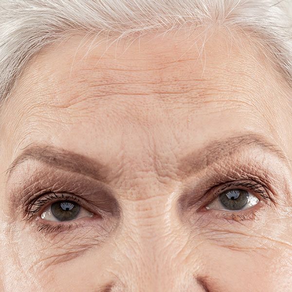 Wrinkles around a woman's eyes