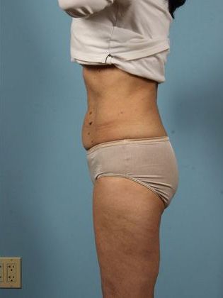 after coolsculpting