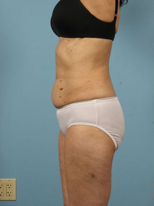 before coolsculpting
