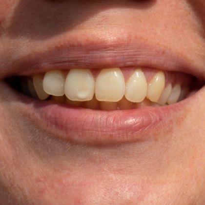 A patient with tooth discoloration