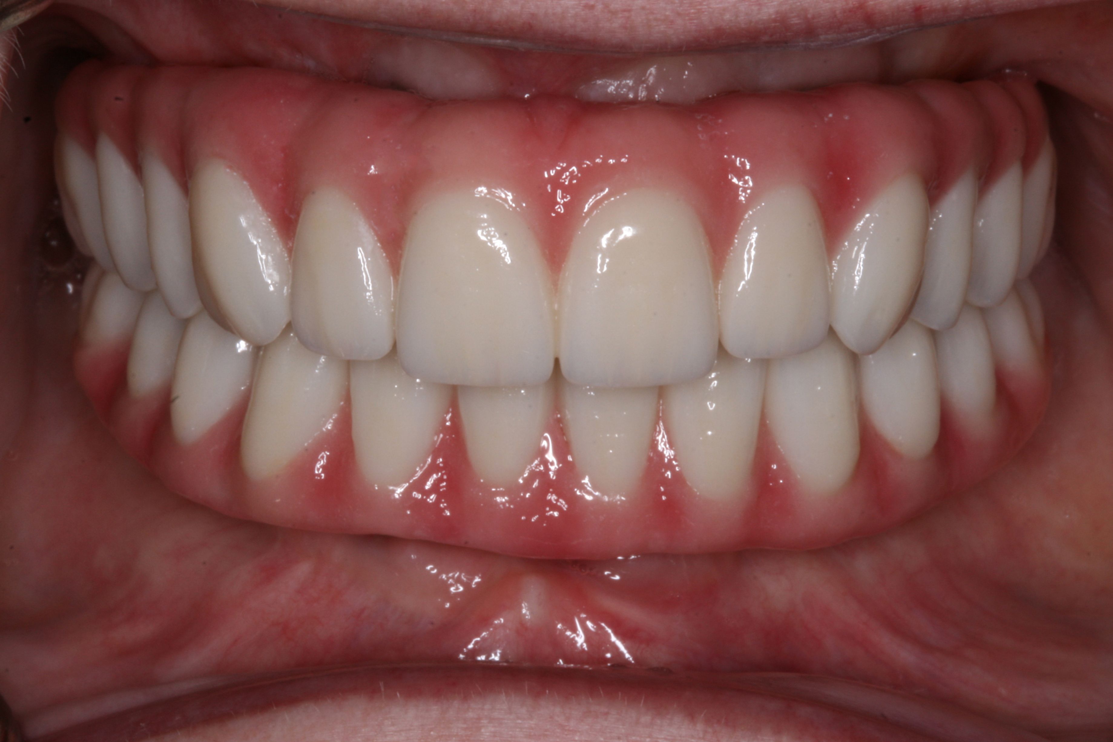 A beautiful, complete smile after dental implants and a restoration