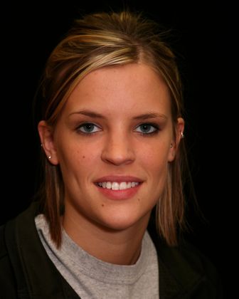 Before veneer placement