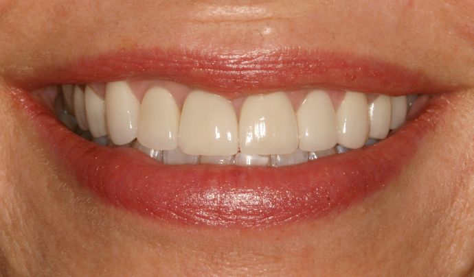 Smile closeup after veneers