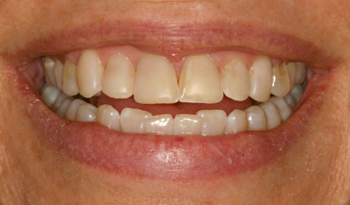 Smile closeup before veneers