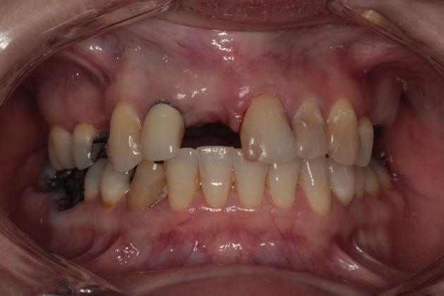 missing tooth and damaged teeth