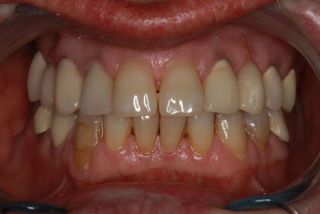 Before crown placement