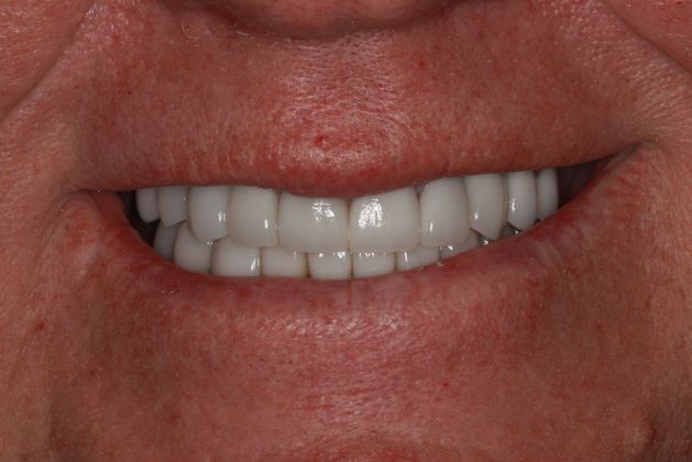 After crown placement