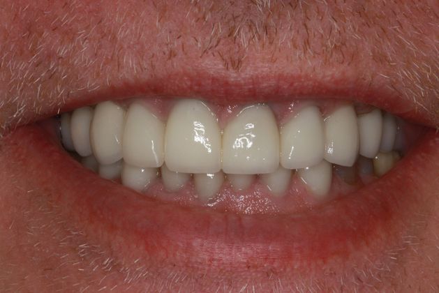 after procedure
