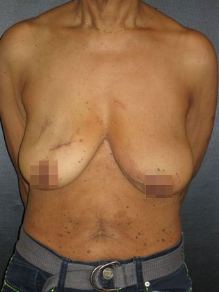 Before breast reconstruction