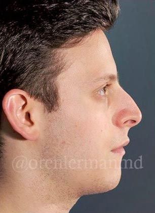 Dr. Oren Lerman's patient before rhinoplasty