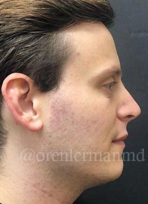 Dr. Oren Lerman's patient after rhinoplasty