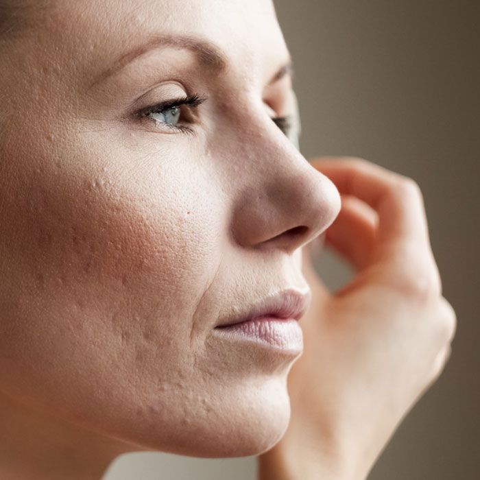 woman's pockmarked face