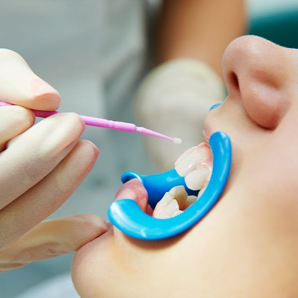 Patient receiving dental sealants
