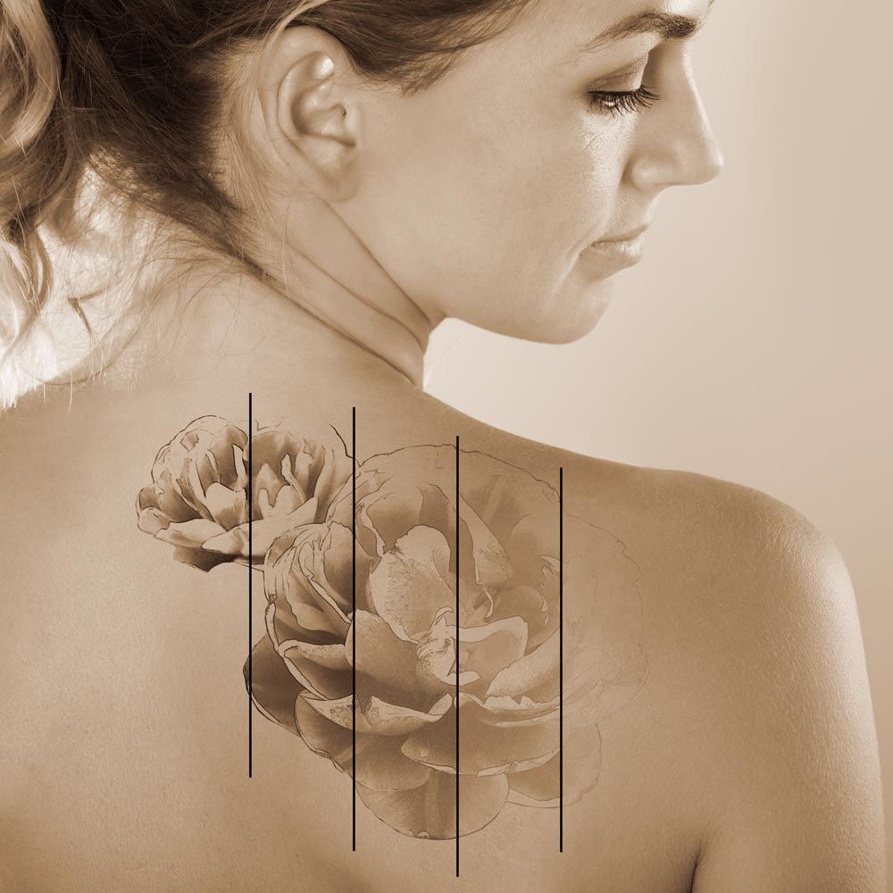 Doctor removing tattoo from upper arm