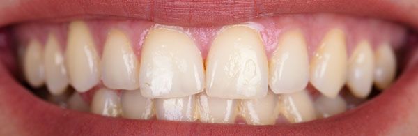 Before Teeth Whitening Picture