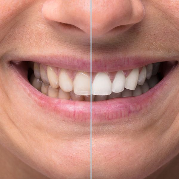 teeth whitening before and after