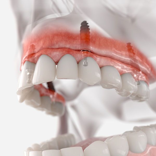 Implant-supported denture