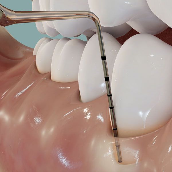 Measuring periodontal pocket