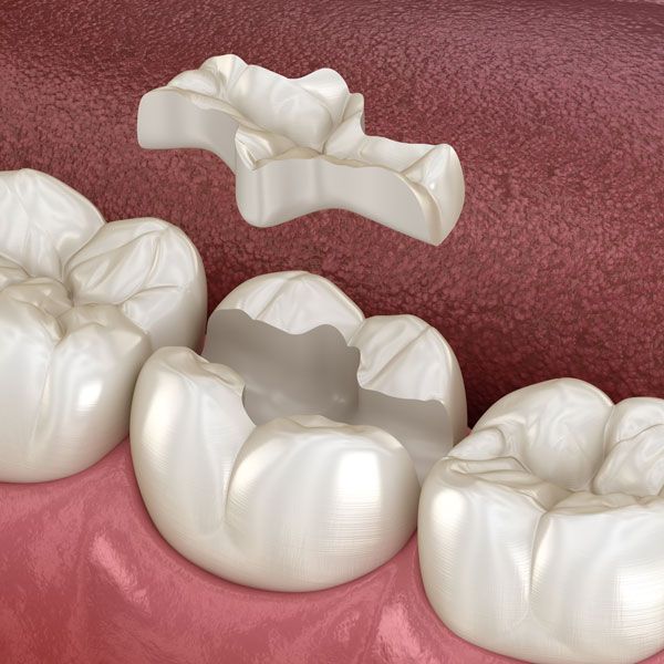 Tooth prepped for inlay