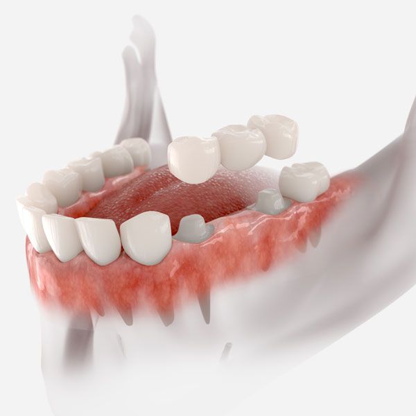 Prepared teeth and dental bridge
