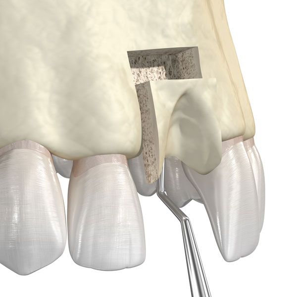Bone graft