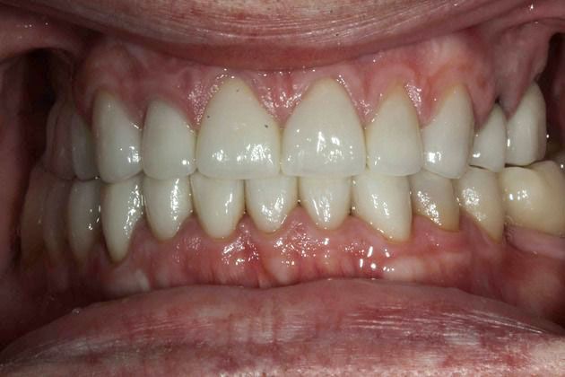 After full mouth reconstruction