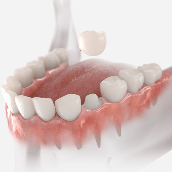 Prepared tooth before crown placement