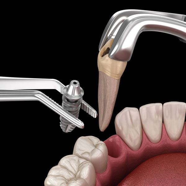 Tooth Extraction