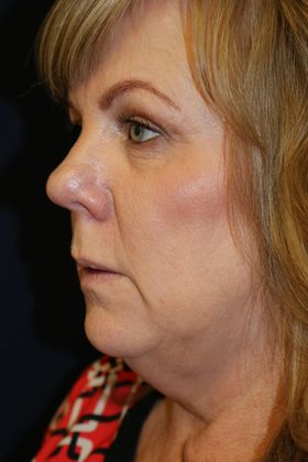 Before Kybella Procedure