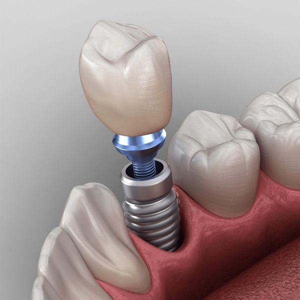 Dental Implants