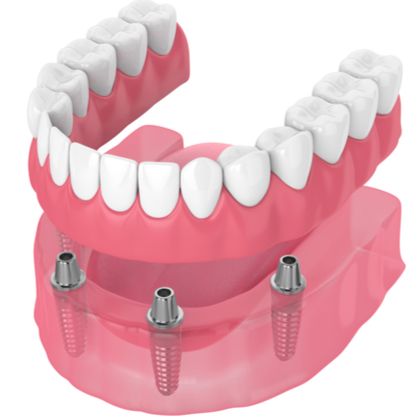 Implant-supported denture