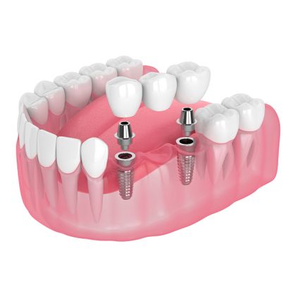 Implant-supported bridge