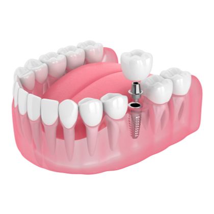 Single dental implant